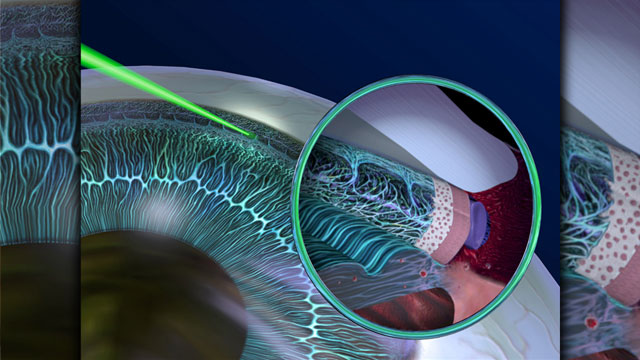 iridotomy